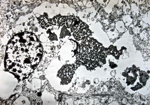 M,71y. | Alzheimer diseaseaccompanied with CADASIL - hyaline body in astrocyte